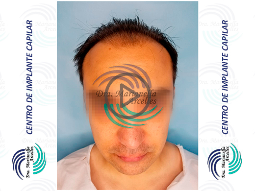 Dra. Arcelles - Centro de implante capilar